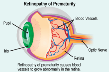A side-view diagram of the eye which shows the pupil, iris, blood vessels, optic nerve and retina and contains the text 'Retinopathy of prematurity causes blood vessels to grow abnormally in the retina'